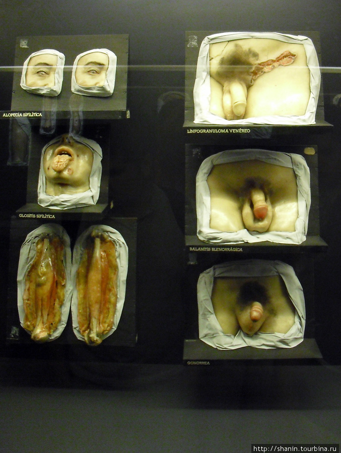 В Музее медицины в Мехико — мужские половые органы, пораженные венерическими заболеваниями Мехико, Мексика