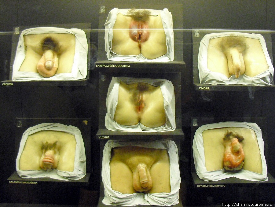 В Музее медицины в Мехико — мужские половые органы в зале венерических заболеваний Мехико, Мексика