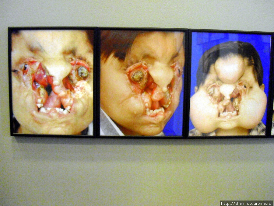 В Музее медицины в Мехико — образцы лицевых патологий Мехико, Мексика