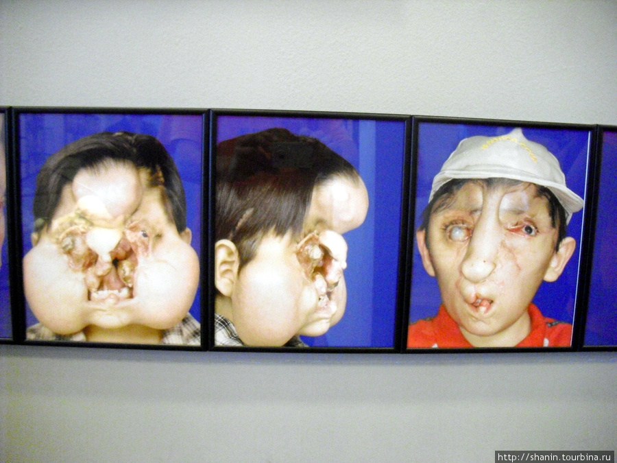 В Музее медицины в Мехико — лицевые патологии Мехико, Мексика